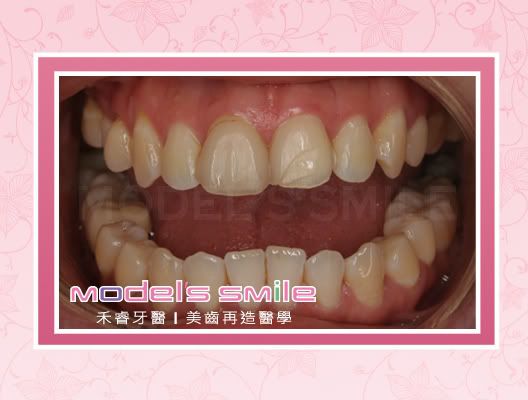 全瓷牙冠治療 前
