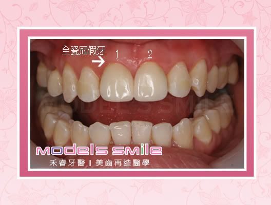 全瓷牙冠治療 後