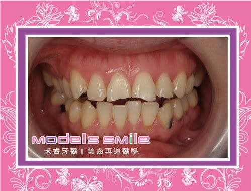 星鑽全瓷冠+雪晶瓷牙貼片 前
